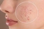 Understanding Acne
