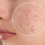 Understanding Acne