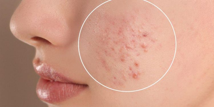 Understanding Acne