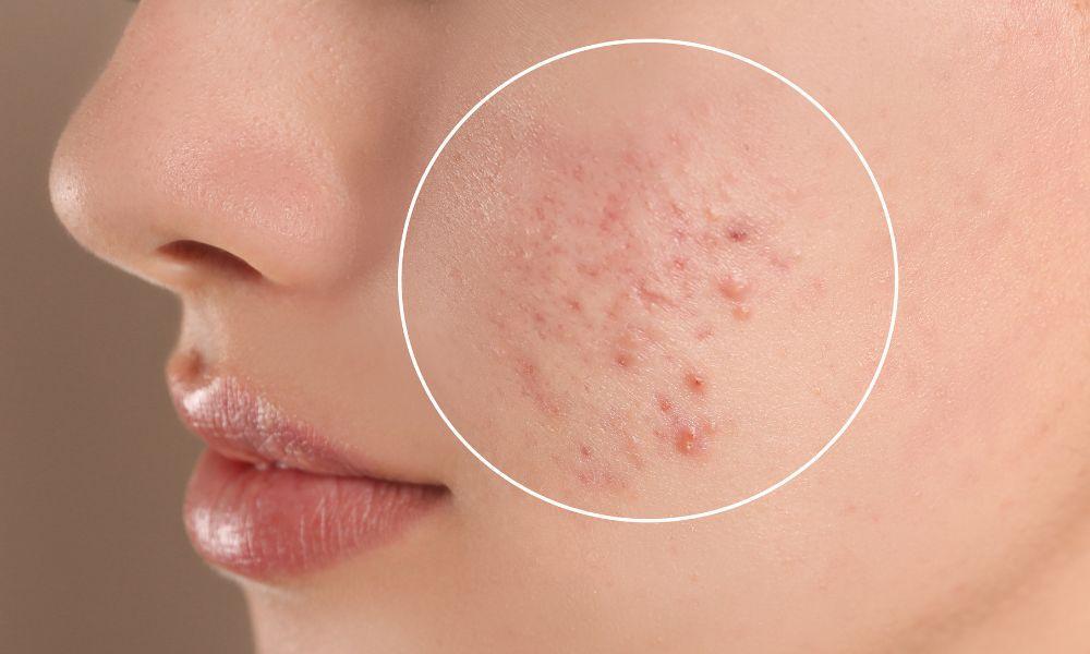 Understanding Acne